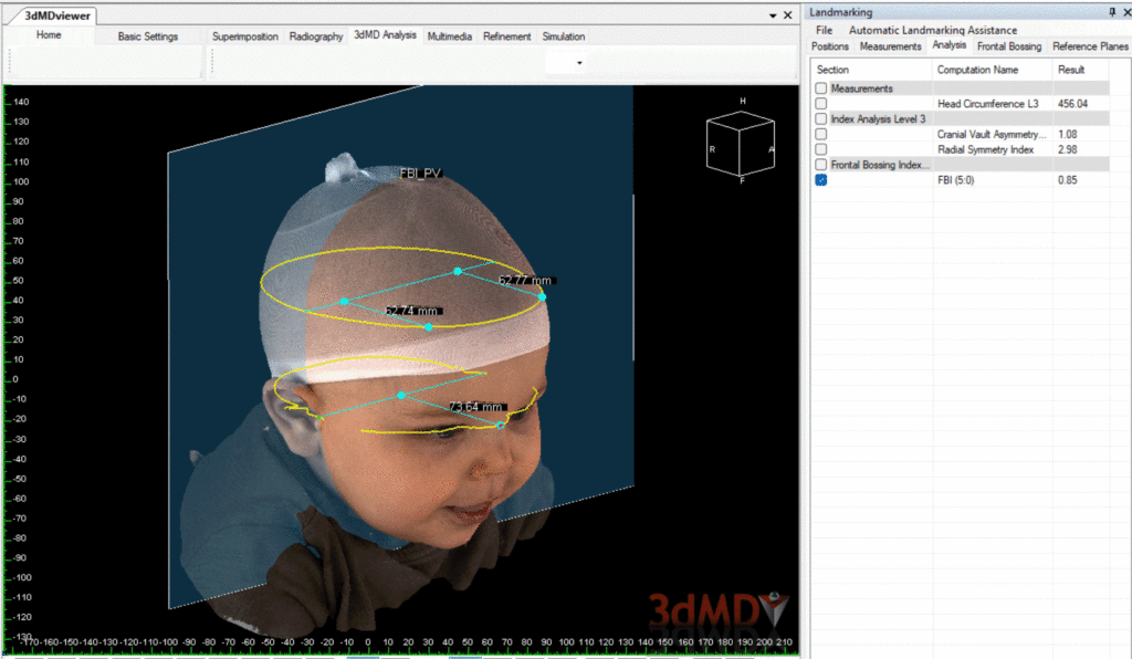 3dMD Announces a Non-Invasive, Pre- and Post-Operative 3D Head ...